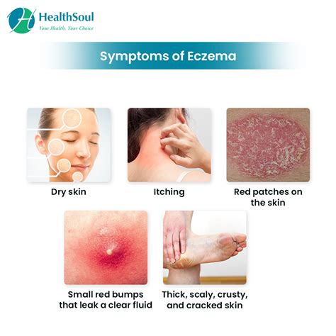Eczema Symptoms Diagnosis And Treatment Healthsoul