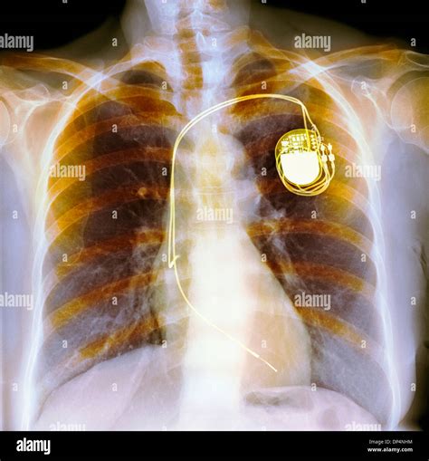Dual Chamber Pacemaker X Ray Hi Res Stock Photography And Images Alamy