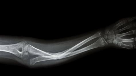 Graphene Shows Promise For Repairing Broken Bones