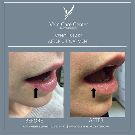 Venous Lake Before And After Lima Ohio Vein Care Center