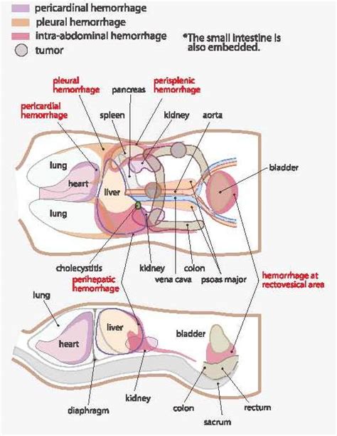 Faster Fan Focused Assessment Sonography For Trauma Acute Abdomen