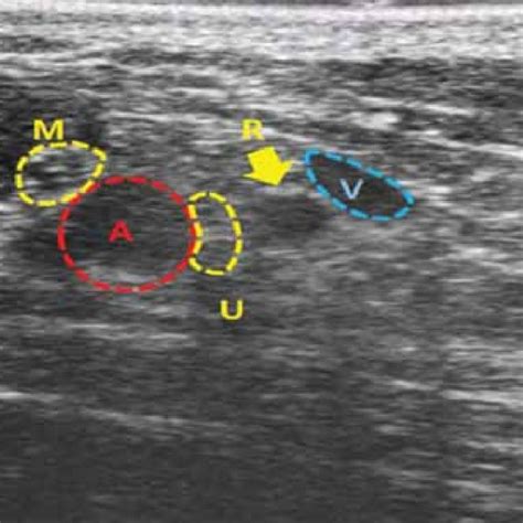 Ultrasound Imaging Of The Brachial Plexus Showing The Median Nerve M