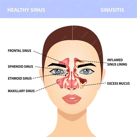 Premium Vector Sinusitis Healthy And Sinus Infections Signs Realistic