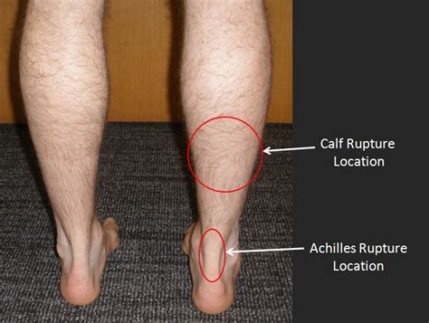 Calf Muscle Tear Footeducation