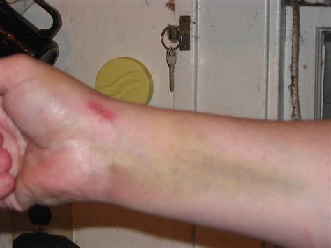 Right Wrist Bruise From 12 29 06 Accident 2 Flickr Photo Sharing