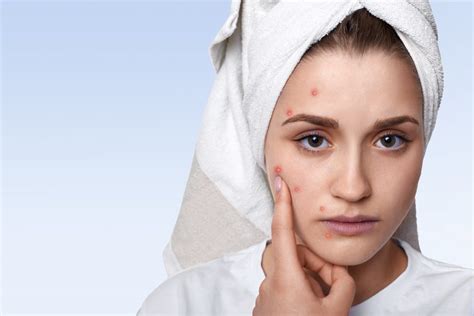 6 Effective Ways To Prevent Acne I3l