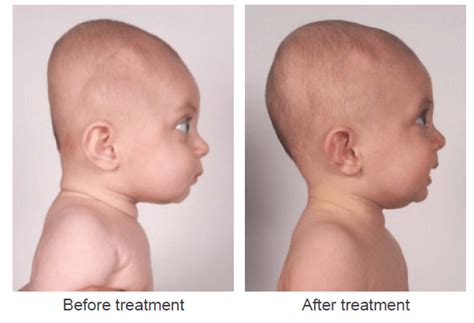What Is Flat Head Syndrome Cherish Baby Care