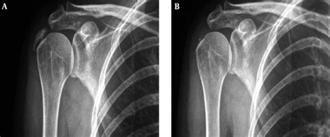 Right Shoulder Calcifying Tendonitis CT In A Patient Of The Study Download Scientific