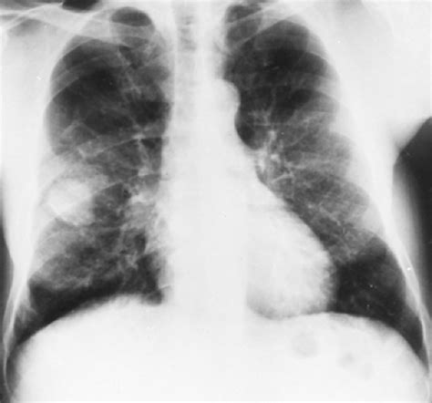 Uncommon Primary Malignant Tumors Of The Lung Thoracic Key