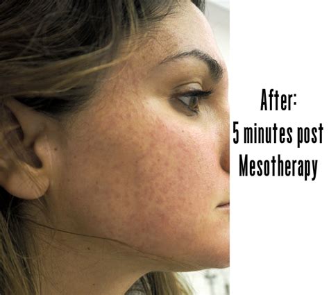 Ffg Beauty Review Mesotherapy Skin Prick Nutrition