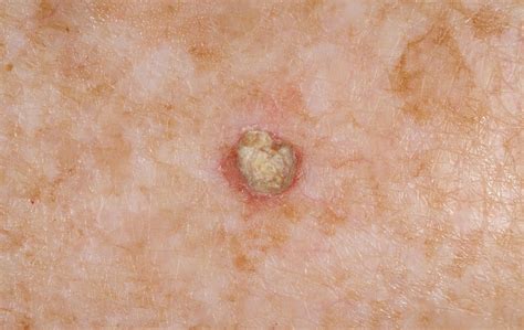 Precancerous And Malignant Skin Conditions Actinic Keratosis Bcc Scc Hot Sex Picture