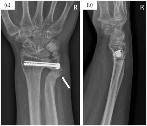 Follow Up Ap A And Lateral B Radiographs Of The Right Wrist 18