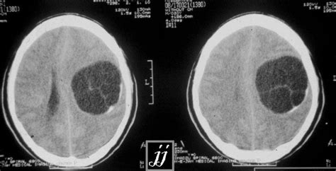 Hydatid Cyst Brain Ct Axial Rare Multivesicular Spot Diagnosis