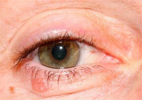 Early Basal Cell Carcinoma Eyelid