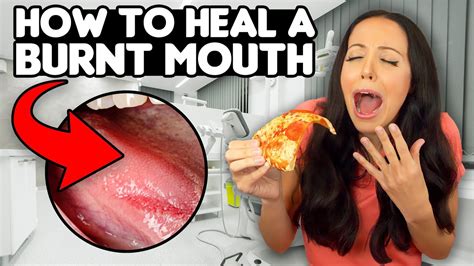 6 Quick Ways To Heal A Burnt Mouth Etoners