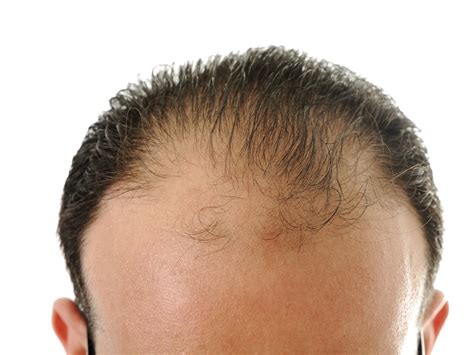 Hair Loss Treatment Dermatologists Report Incredible Results For