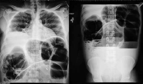Erect Chest And Abdominal X Rays Showing Dilated Colon And Air Fluid