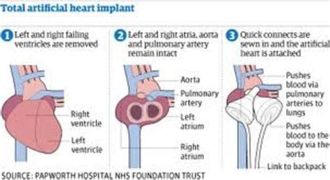 The Artificial Heart Timeline Timetoast Timelines