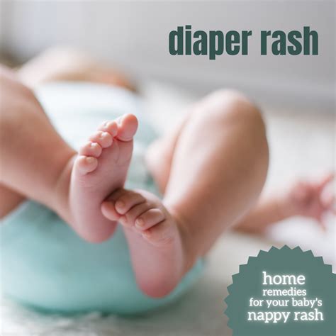Home Remedies For Diaper Rash Nappy Rash Wehavekids