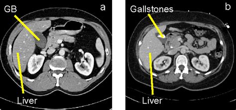 Gallbladder On Ct Scan