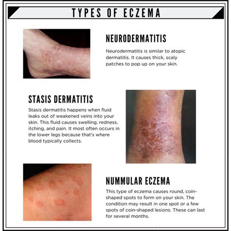 7 Types Of Eczema And Its Symptoms Banish