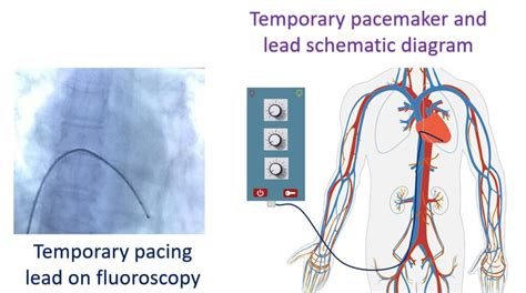 What Is Temporary Pacing All About Heart And Blood Vessels