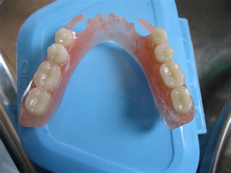 Dento Care Dental Clinics Flexible Dentures As Immediate Denture