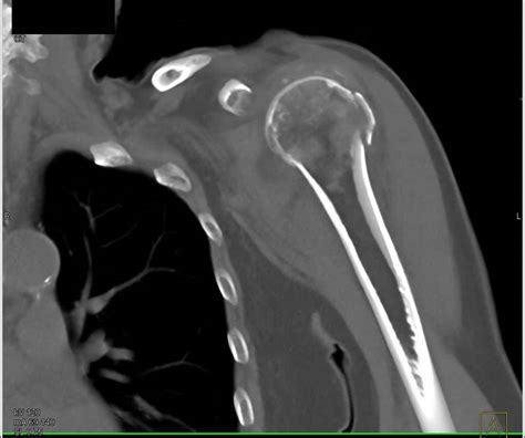 Humerus Neck Fracture With Associated Hematoma Trauma Case Studies
