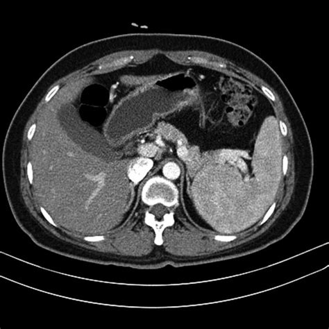 Multi Phase Contrast Enhanced Abdominal Computed Tomography