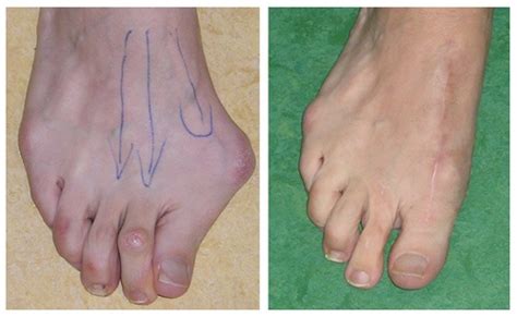 Hallux Limitus And Rigidus Sydney Big Toe Arthritis Treatment Sydney Nsw