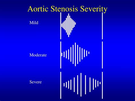 Ppt Aortic Stenosis Powerpoint Presentation Free Download Id4501578