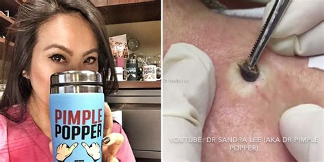 It legit looks like a piece of brain! Dr. Pimple Popper Is Casting People for Her Show!