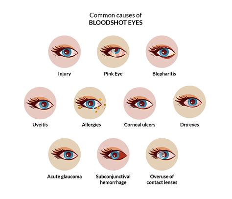 What Causes Bloodshot Eyes Smartbuyglasses Ie