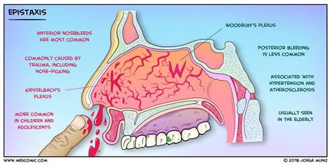 Epistaxis Pathophysiology Nursing Top Nursing Schools Medical