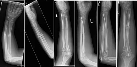 Surgical Treatment Of Nonunion Of A Mid Shaft Fracture After