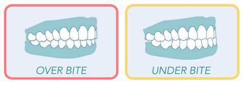 Overbite Vs Underbite What It Is And How To Fix With Mewing