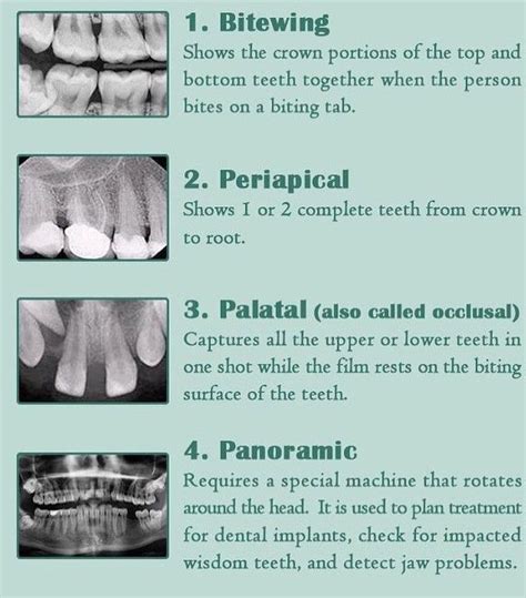 Types Of Dental X Rays Medizzy