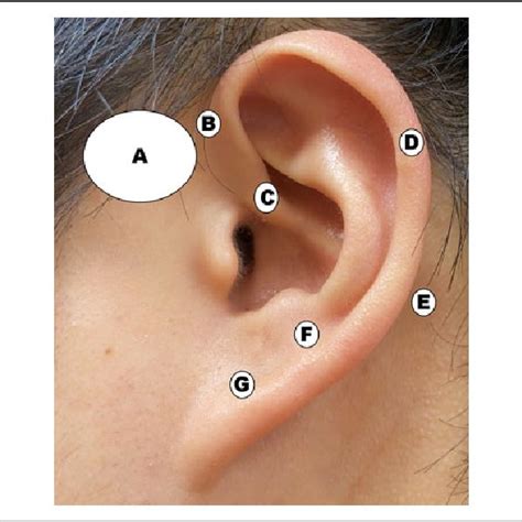 Posterior Helicine Type Of Preauricular Fistua A Small Pit White