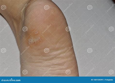 Close Up Shot Of A Plantar Wart On The Bottom Of A Foot Heel Caused By