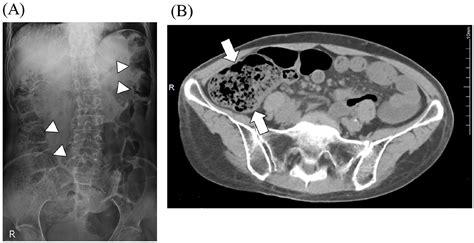 Ultrasonographic Evaluation Of Large Bowel Obstruction With Fecal