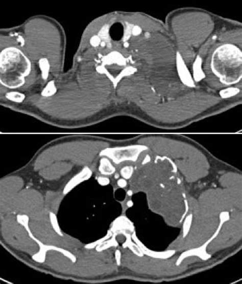 P185 Concomittant Intrathoracic Extrapulmonal And Cervical Hydatid Cyst