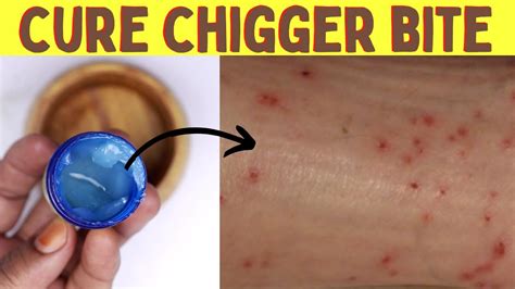 How To Get Rid Of Chigger Bites On Your Body And Skin Naturally At Home