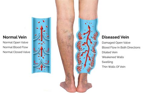 Varicose Vein Treatment San Diego Top Vein Clinic