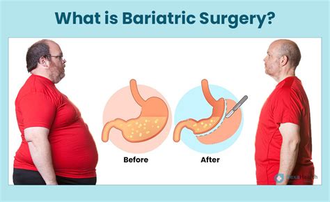 Bariatric Surgery Risks Benefits Complications Recovery