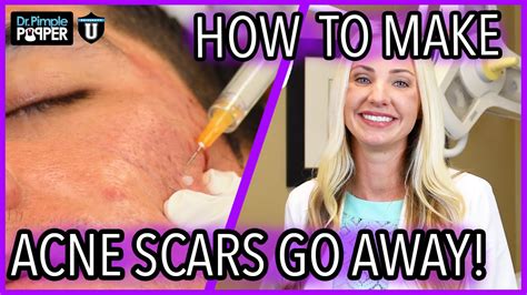 Video How To Make Acne Scars Go Away Before And After