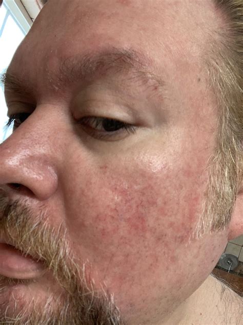 Could Somebody Tell Me What This Is Rosacea Eczema Psoriasis Or It