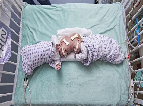 Twin Girls Conjoined At The Head Successfully Separated By 30 Strong