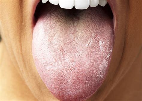 علت سفیدی زبان چیست و چطور می توان آن را درمان کرد؟ روزیاتو