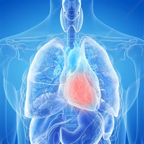 Illustration Of An Inflamed Heart Stock Image F0236828 Science