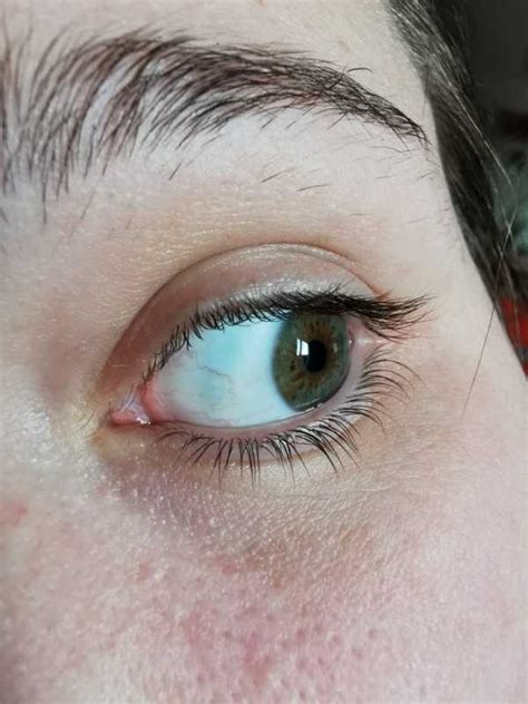 A Blue Spot Appeared In My Eye Out Of Nowhere Should I Be Worried